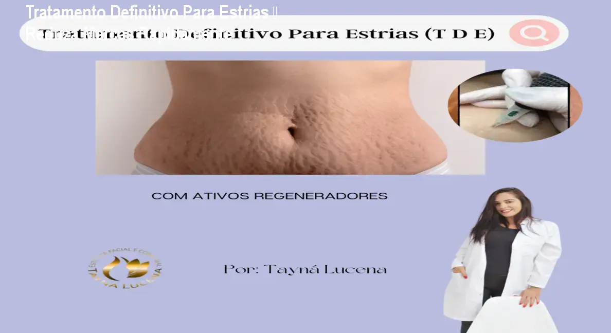 tratamento definitivo para estrias 1